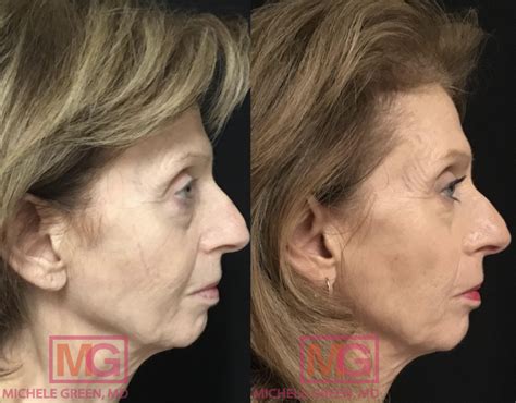 Thermage Before And After Photos Skin Tightening Patient Photo