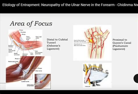 Ulnar Nerve Entrapment Syndrome —