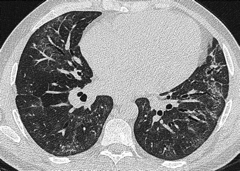 Lung Complications Of Sjogren Syndrome European Respiratory Society