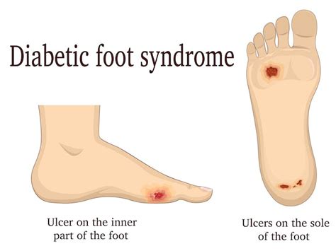 How To Treat A Diabetic Foot Ulcer