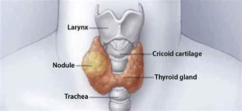 Thyroid Nodules What Is It Overview Diagnosis And Treatment