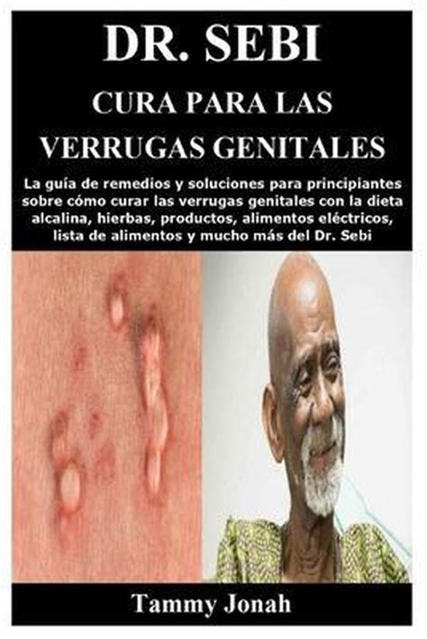 Dr Sebi Cura Para Las Verrugas Genitales La Gu A De Remedios Y