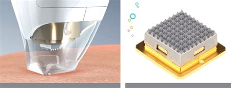 Tixel® is a treatment using fractional thermomechanical ablative technology to tighte.n the skin, iron out wrinkles , improve the appearance of scars and reduce pores. Tixel - Swissmed
