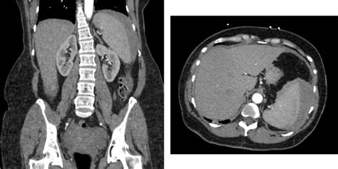 Computed Tomography Images Of Atraumatic Splenic Rupture Download