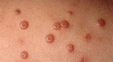 Molluscum Contagiosum To Treat Or Not To Treat Dermcasttv