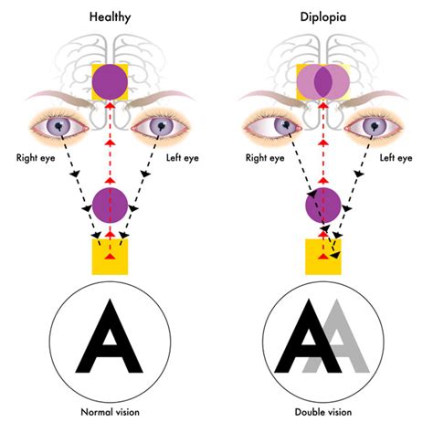 Diplopia Double Vision Sydney Eye Specialists And Ophthalmologists