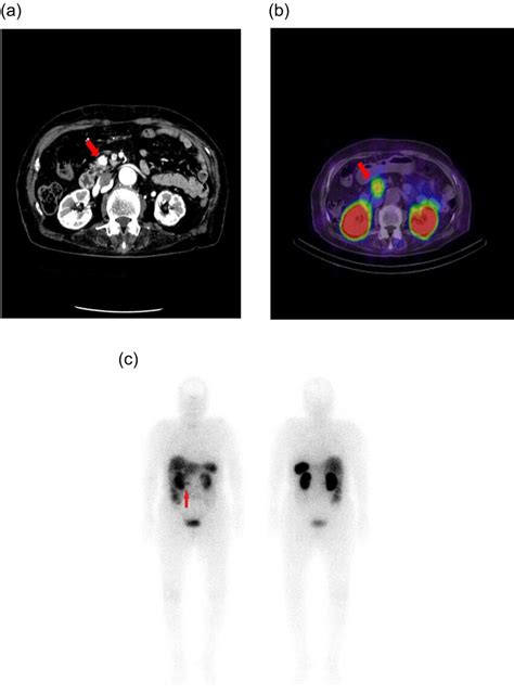 Enhanced Computed Tomography And Octreoscan Scintigraphy Images A
