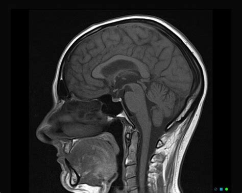 Mri Scan Brain 564 Mri At Melbourne Radiology Clinic