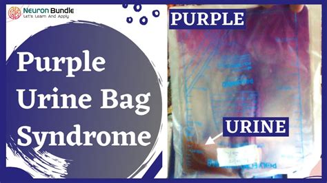 Purple Urine Bag Syndrome Aetiology Management Urinediscolouration