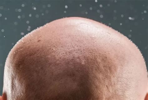 Do Bald People Get Dandruff The Bald Blog