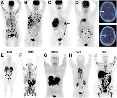 Biology Of Cancer And Pet Imaging Pictorial Review Journal Of