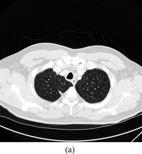 Chest X Ray Pa View Showing Right Paratracheal Opacity Download