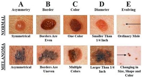 Stages Melanoma Skin Cancer Moles