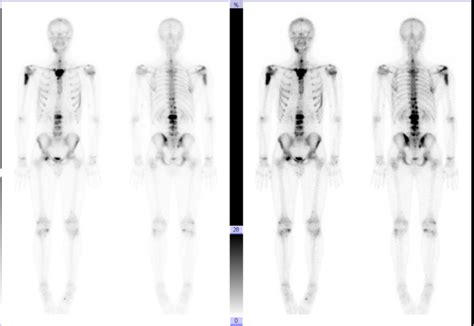 Bone Scintigraphy Showing Multiple Bone Metastases At Time Of Diagnosis