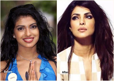When you develop a cataract, the lens of your eye becomes cloudy. Priyanka Chopra Plastic Surgery Before and After Lip Job ...