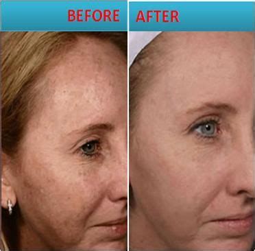 Melasma is a pigmentary ailment characterized by dark, flat patches of skin that typically appear on the face. Best Melasma Treatment