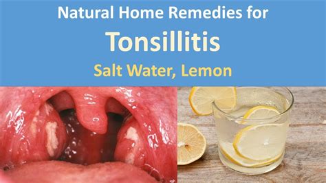 Natural Home Remedies For Tonsillitissalt Water Lemon Youtube
