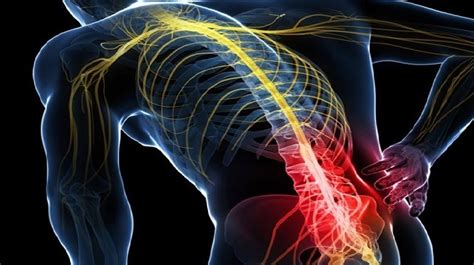 Everything You Need To Know About Sciatica