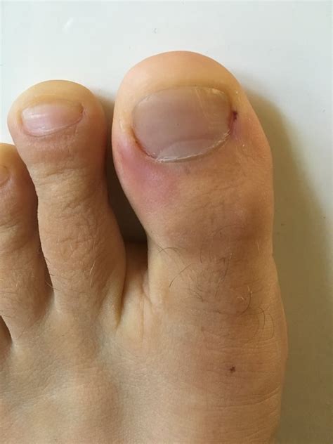 Treating Swollen Toe Cuticles Causes And Solutions For Pain Free Feet