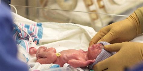Hormone Therapy May Prevent Lung Damage In Premature Infants