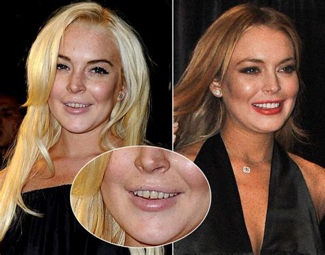 Lindsay Lohan Celebrity Teeth Teeth Health Natural Teeth