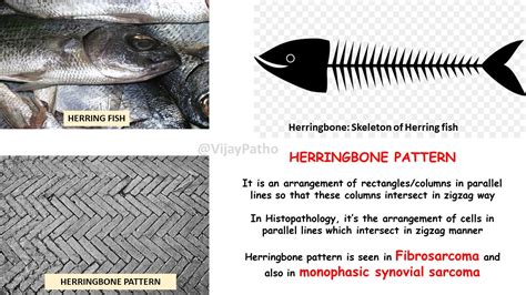 Herringbone Pattern Patternsinhistopathology Pathology Made Simple
