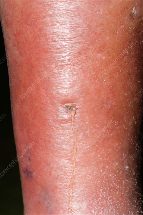 Cellulitis Stock Image M1300924 Science Photo Library
