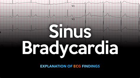 Sinus Bradycardia Ecg Youtube