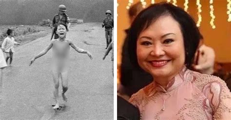 Woman In Napalm Girl Photo Gets Final Treatment Years Later