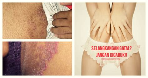 Caranya yaitu dengan menggosokan handuk basa pada kulit anda yang berdaki dengan. Obat menghilangkan bekas gatal yang menghitam pada ...
