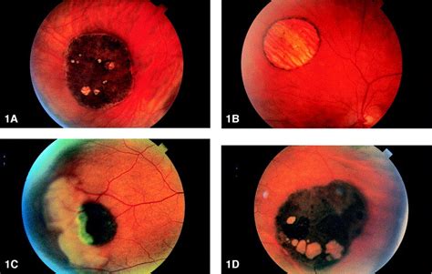 Solitary Congenital Hypertrophy Of The Retinal Pigment Epithelium