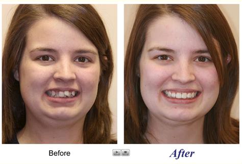 Before And After Photo 3 Smile Makeover Dental Makeover Cosmetic