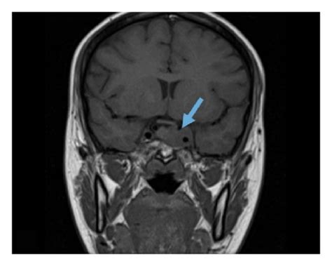 Ct Scan Of The Paranasal Sinuses Showing Complete Opacification Of The