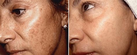 Brown Spotspigmentation Treatments Boston And Wellesley Krauss Dermatology