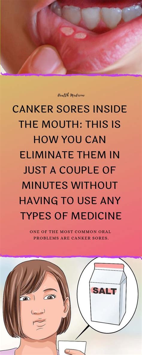 Canker Sores Inside The Mouth This Is How You Can Eliminate Them In