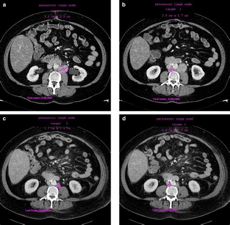 Ct Scans Of A Patient With Cervical Cancer Who Experienced A Confirmed