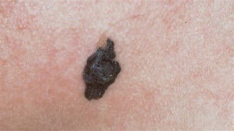 Identifying Skin Cancer 37 Photos You Need To See The Weather Channel