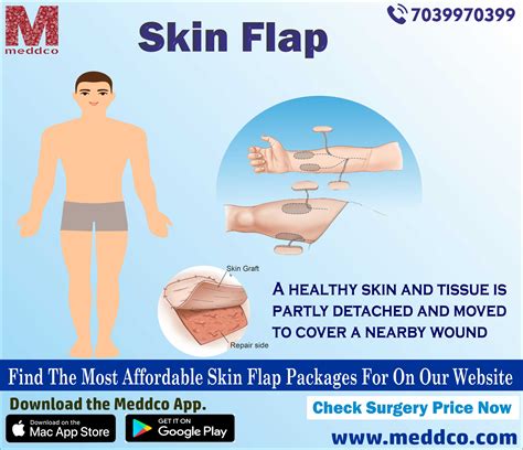 What Are Different Types Of Flap Surgeries