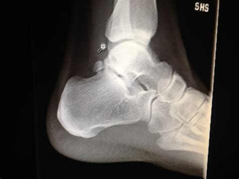 Foot And Ankle Problems By Dr Richard Blake Ankle Injuries Fractured
