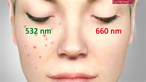 Freckles Pigmentation Treatment Singapore Ruvy Touch Pico Laser Dr