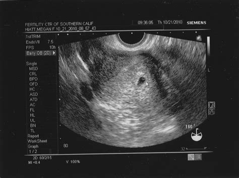 By the time you're 10 weeks pregnant, your embryo will officially be called a fetus! The Spamdrew Family: Pregnancy Graduation