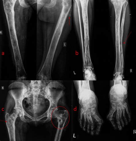 Polyostotic Fd Plain Radiographs Same Patient As In Fig6 Ab