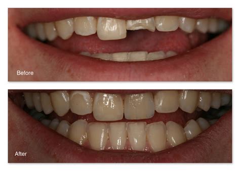 Restoration Of Fractured Teeth Gallery Dr Jack M Hosner Dds