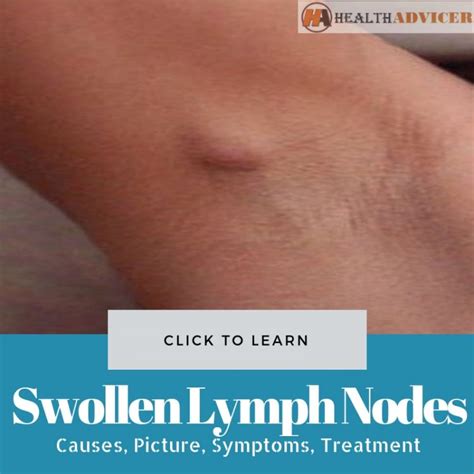 Swollen Lymph Nodes Upper Arm