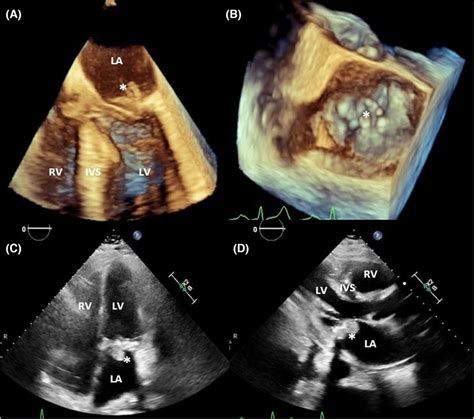 Three‐dimensional Transesophageal Echocardiography Showing Mobile