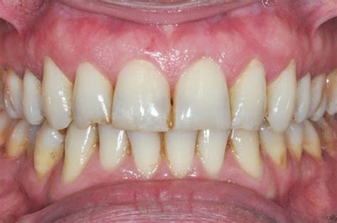 I just started noticing that between my teeth are starting to turn brown. Dr Pulp's Blog