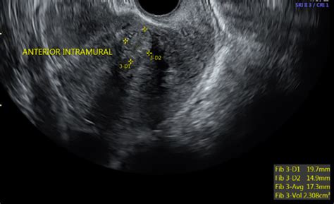 Figure Transvaginal Ultrasound Sagittal Image Of Statpearls