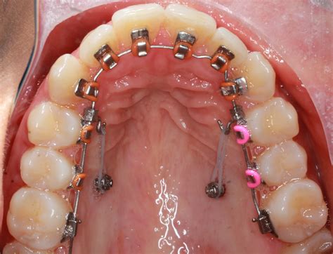 In Ovation L Mtm Orthodontist San Diego Clear Braces