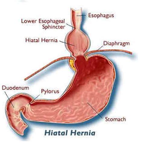 Epigastric hernias can appear during imaging tests for other medical conditions. Symptoms of a Hernia in a Woman