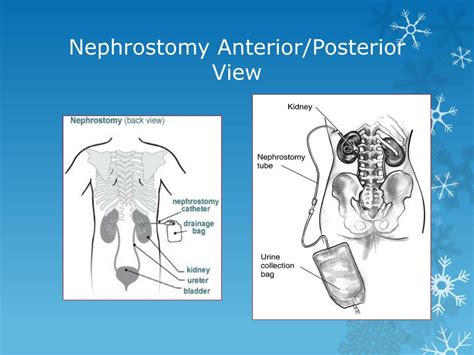 Ppt Urinary Nephrostomy Catheter Care Powerpoint Presentation Free